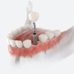 Proper aftercare ensures the longevity and success of dental implants. Patients must adhere to specific guidelines to facilitate healing.